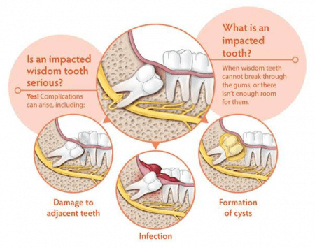 Do You Need to Remove Impacted Wisdom Teeth?